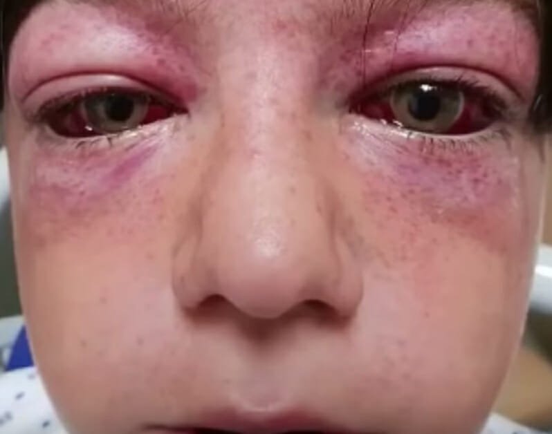 Playground craze leaves 11-year-old boy “looking like an alien” – mom issues warning for parents