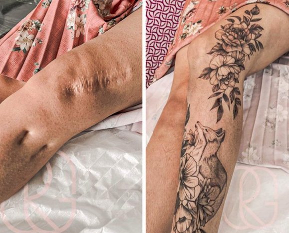 You can make scars look gorgeous with tattoos.