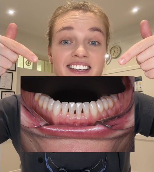 The meaning of having black triangles between your teeth is explained by the dentist.