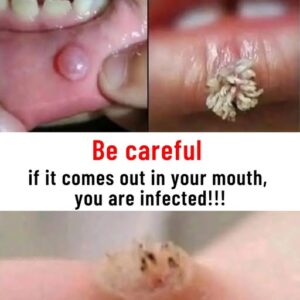 2/ Be very careful if it comes out in your mouth, you are infected 2/ Be very careful if it comes out in your mouth, you are infected